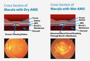 Age Related Macular Degeneration Amd A Definitive Guide - 